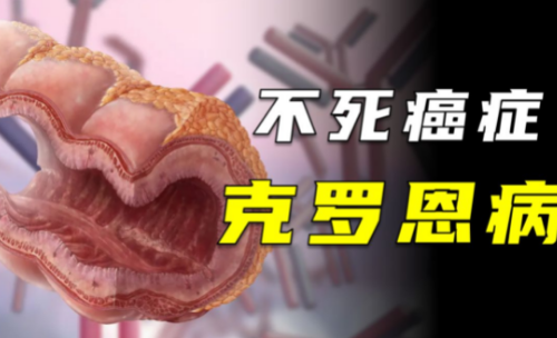 克罗恩病与“美人病”之称的缘由，说法是什么？