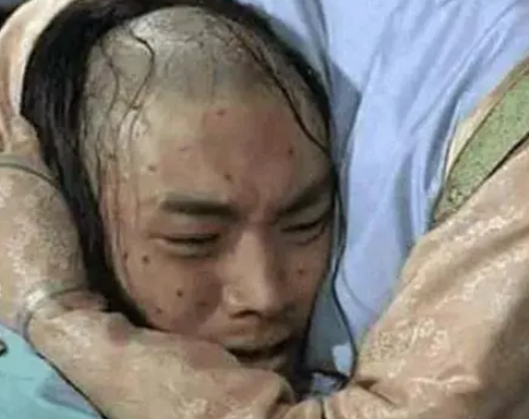 天花病毒的消灭：人类战胜疾病的壮举