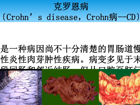 克罗恩病：最长不复发的记录与管理策略