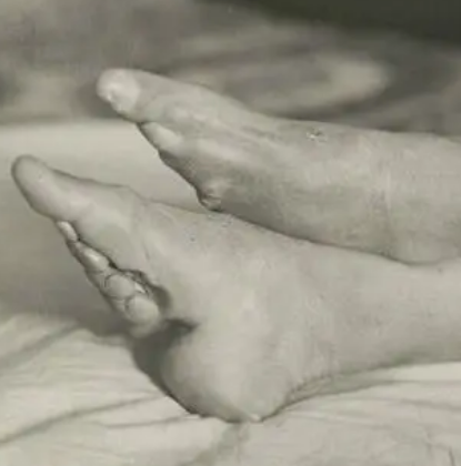 女人裹脚的废除：一段历史的转变