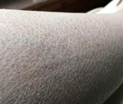 冬日“手”护指南：告别脱皮，重获柔嫩双手