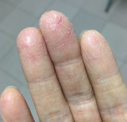 告别手指开裂：科学护理与预防全攻略