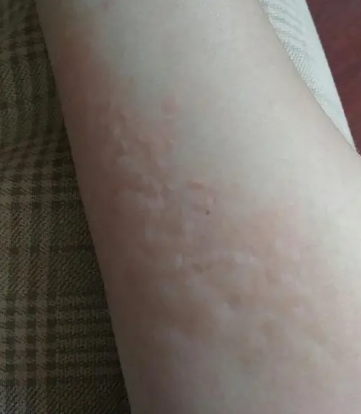 十大罕见的特殊过敏是什么？最离谱的是什么过敏？